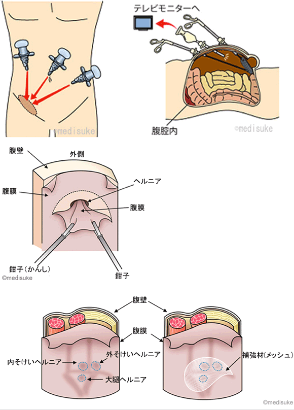 腹腔鏡下鼠径ヘルニア修復術